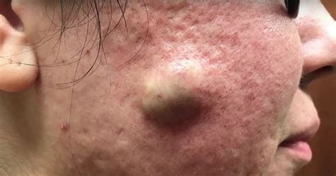 On Wednesday, dermatologist <b>Dr</b>. . Dr pimple popper cyst videos